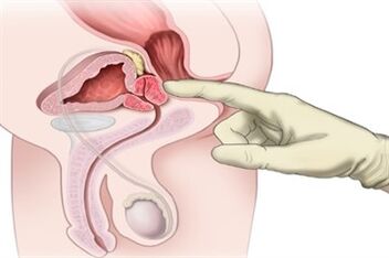 Μασάζ προστάτη για τη θεραπεία της χρόνιας προστατίτιδας
