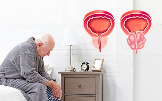 Προστατίτιδα σε άνδρα